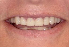 The image shows a person with a wide smile, displaying their teeth and gums, with a focus on the lower front teeth and upper lip.
