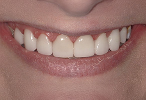 The image shows a close-up of a person s smiling face with teeth, featuring a wide grin and a bright smile.