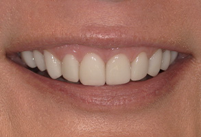 The image shows a close-up of a person with a wide smile displaying white teeth, set against a neutral background.