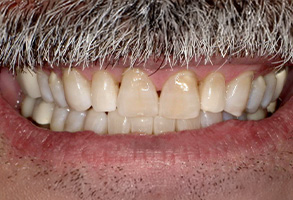 The image shows a close-up of a person s mouth with yellowed teeth and a partial mustache, featuring a smile with multiple teeth visible.