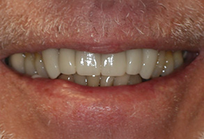 The image shows a close-up of a person s mouth with a broad smile, revealing teeth and gums, against a neutral background.