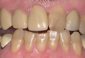 The image shows a close-up view of a person s teeth with visible signs of decay and discoloration, including yellowing and cavities.