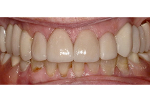 The image displays a close-up of a person s teeth with a focus on a significant amount of staining and decay, suggesting poor oral hygiene.