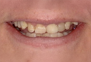 A person s smiling face with crooked teeth.