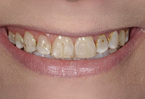 The image shows a close-up view of a person s smiling face with a set of teeth that appear to be enhanced with cosmetic dental work, including what looks like veneers or orthodontic treatments.