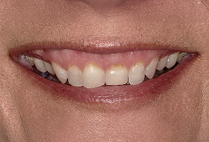 The image shows a close-up of a person s smile with teeth visible, against a neutral background.
