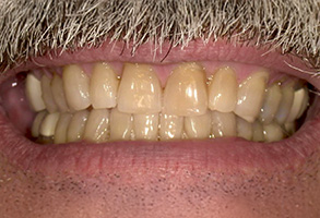 The image shows a close-up of a person s mouth with yellowed teeth and a mustache.