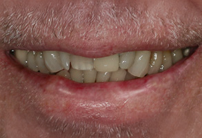The image shows a close-up of a person s face with a wide grin, displaying yellowed teeth and gum disease, against a neutral background.