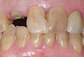 The image shows a close-up view of a person s mouth with severely decayed teeth and a rotten gum line, highlighting dental neglect and poor oral hygiene.