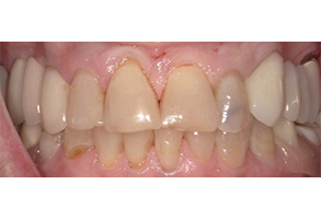 The image displays two sets of teeth with varying degrees of decay and discoloration, showcasing different stages of dental health issues.