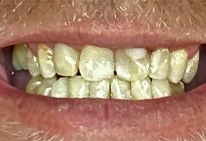 The image shows a person s mouth with a large amount of yellowish-green staining on their teeth, which appears to be due to tobacco use, and they are missing a tooth.