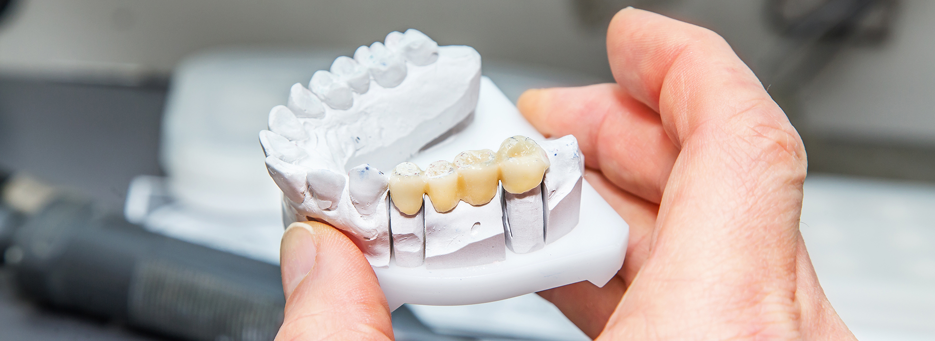 A person holding a denture with multiple teeth missing, showing it against a white background.