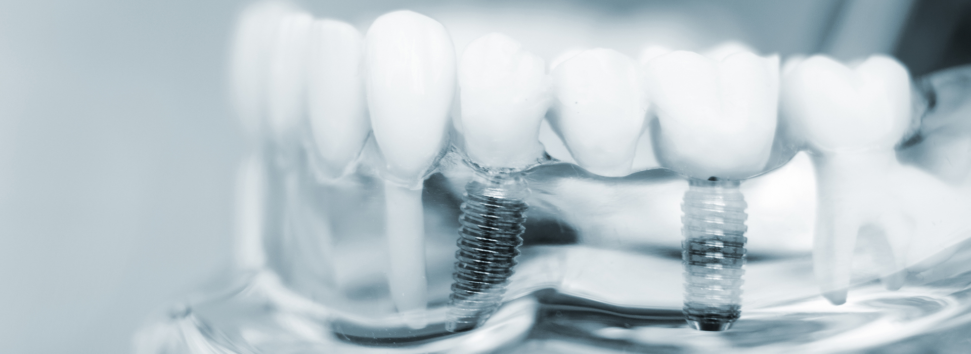 The image displays a close-up view of a dental implant fixture with multiple screws and a clear plastic top, set against a blurred background.