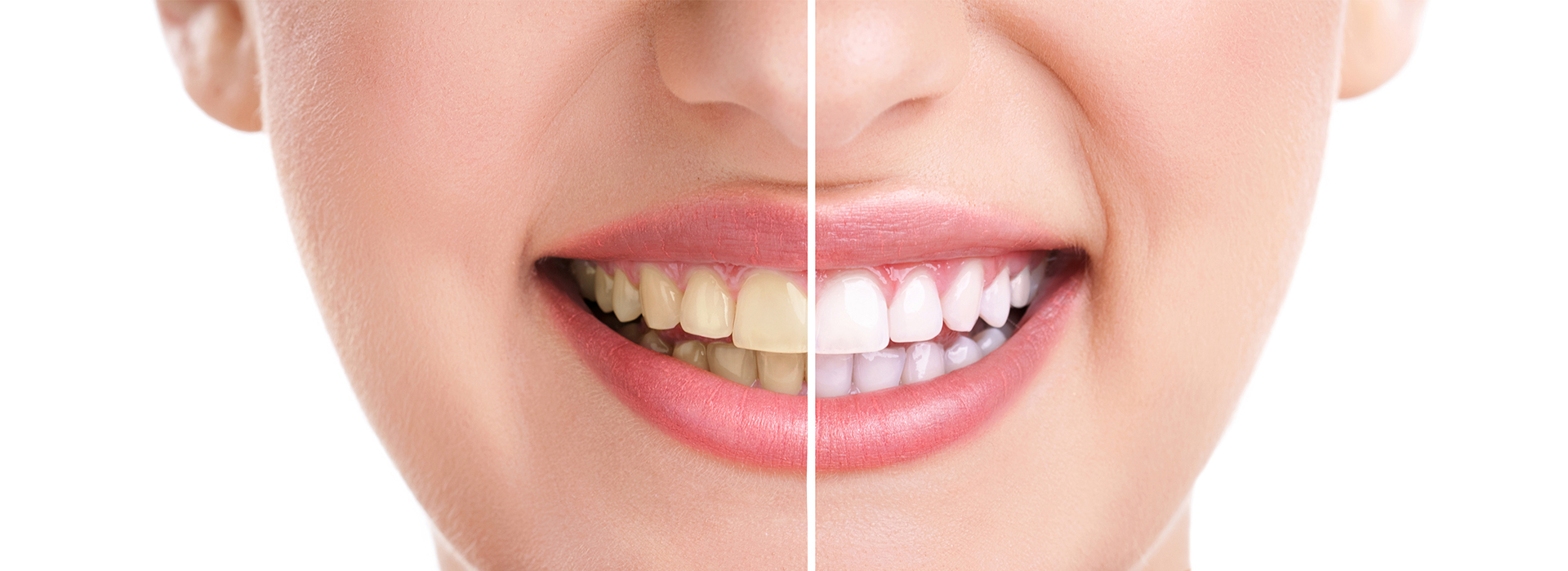 The image shows a close-up view of a person s face with a focus on their teeth, which appear to be well-maintained and possibly enhanced through cosmetic dental procedures.